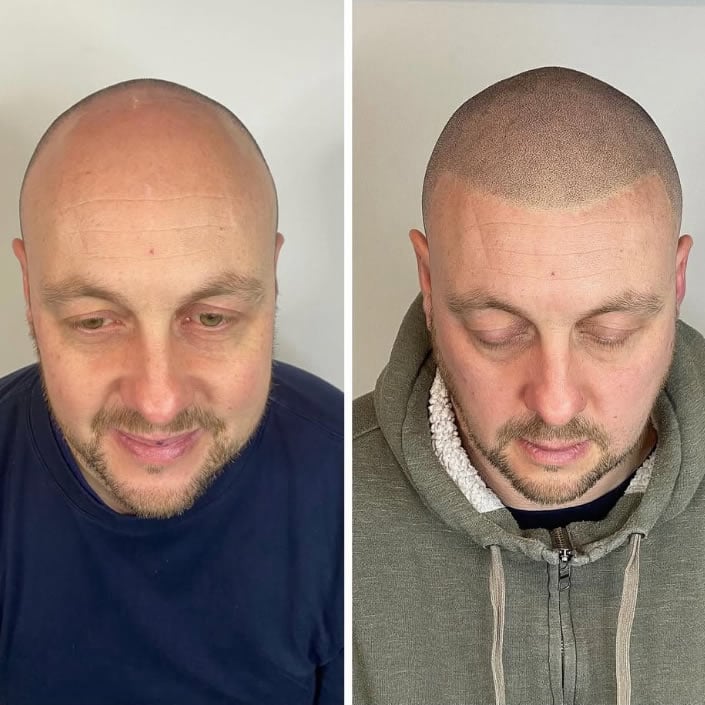 Scalp tattooing near me